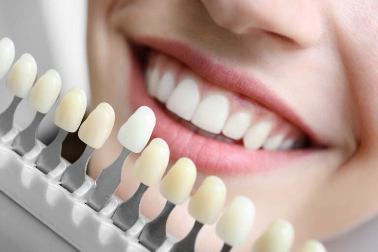 teeth whitening at dentist colour comparison
