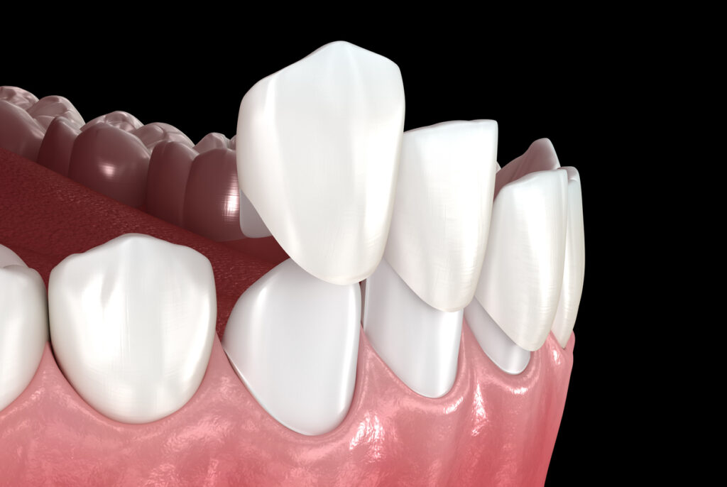 Composite Bonding vs Porcelain Veneers: Which Is Better for Your Smile? 1 composite bonding vs porcelain veneers teeth