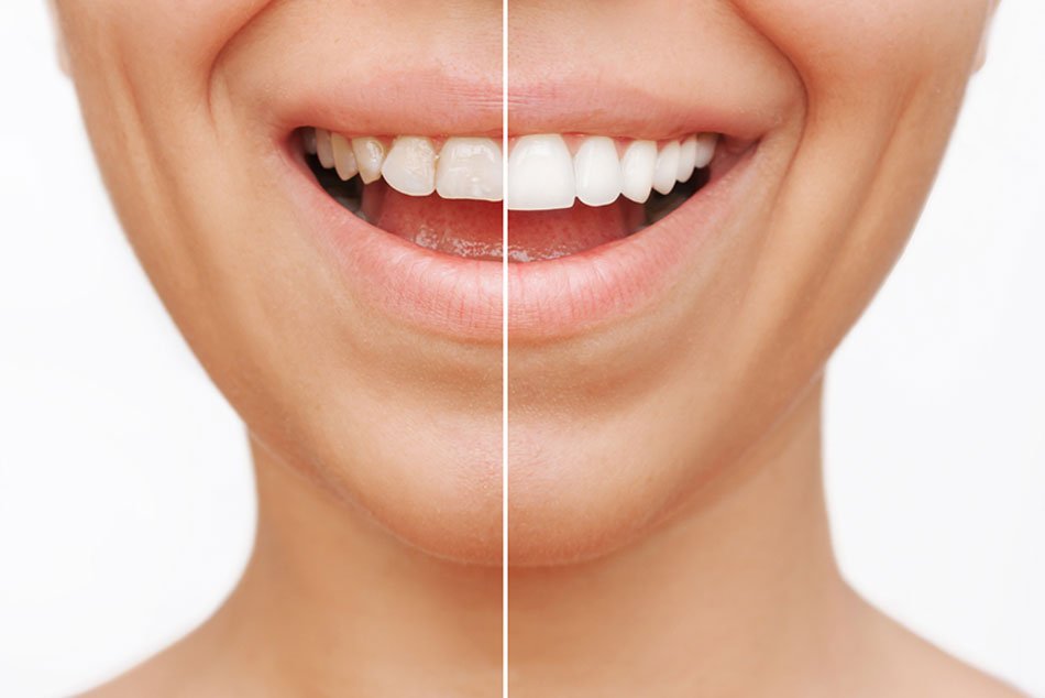composite bonding vs porcelain veneers learn the difference before and after