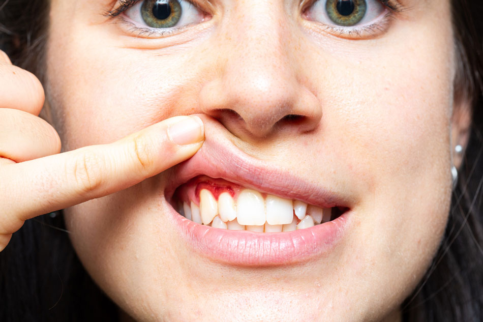 bleeding gums by honeyfields lady and gums