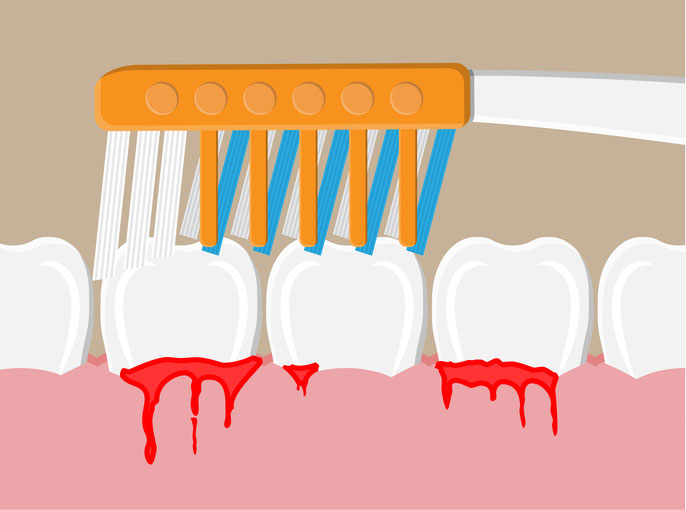bleeding gums by honeyfields cartoom teeth and brush