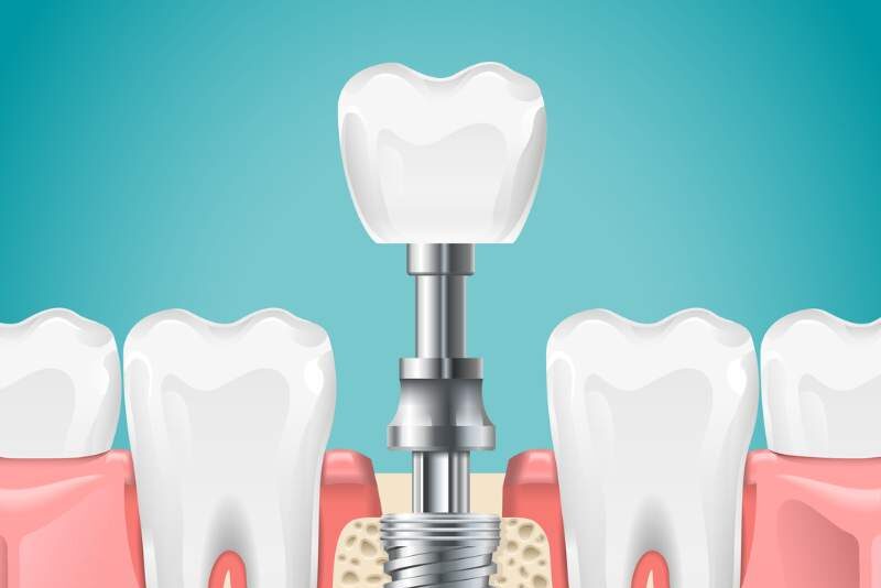 Honeyfields dental implants for missing front teeth