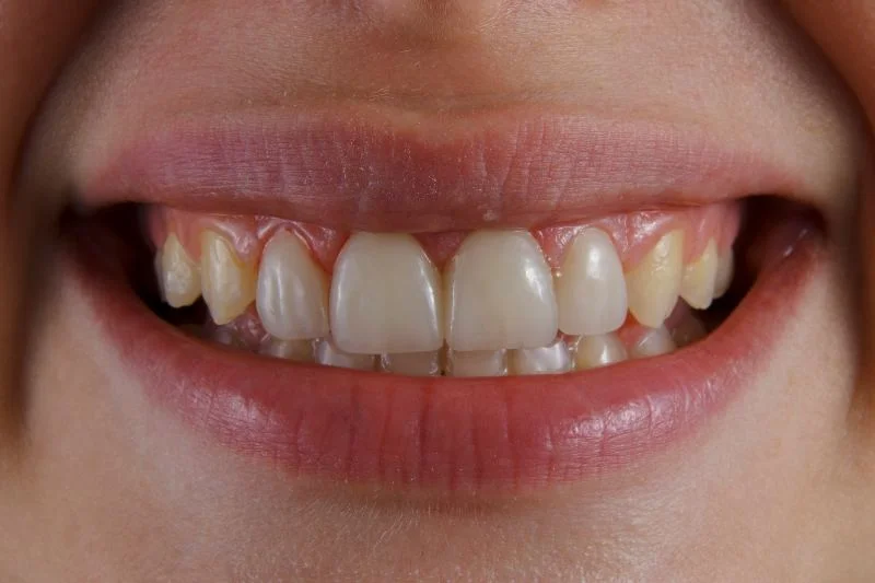 Teeth Reshaping: A Quick, Painless Way to Refine Your Smile 2 Teeth Reshaping: A Quick, Painless Way to Refine Your Smile - North Wales Dentist, Rhuddlan
